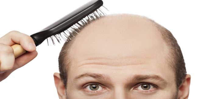 How to Stop Frontal Hair Loss in Men